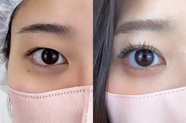 自然な仕上がりの二重整形｜日本で受ける双眼皮手術のポイントとは？